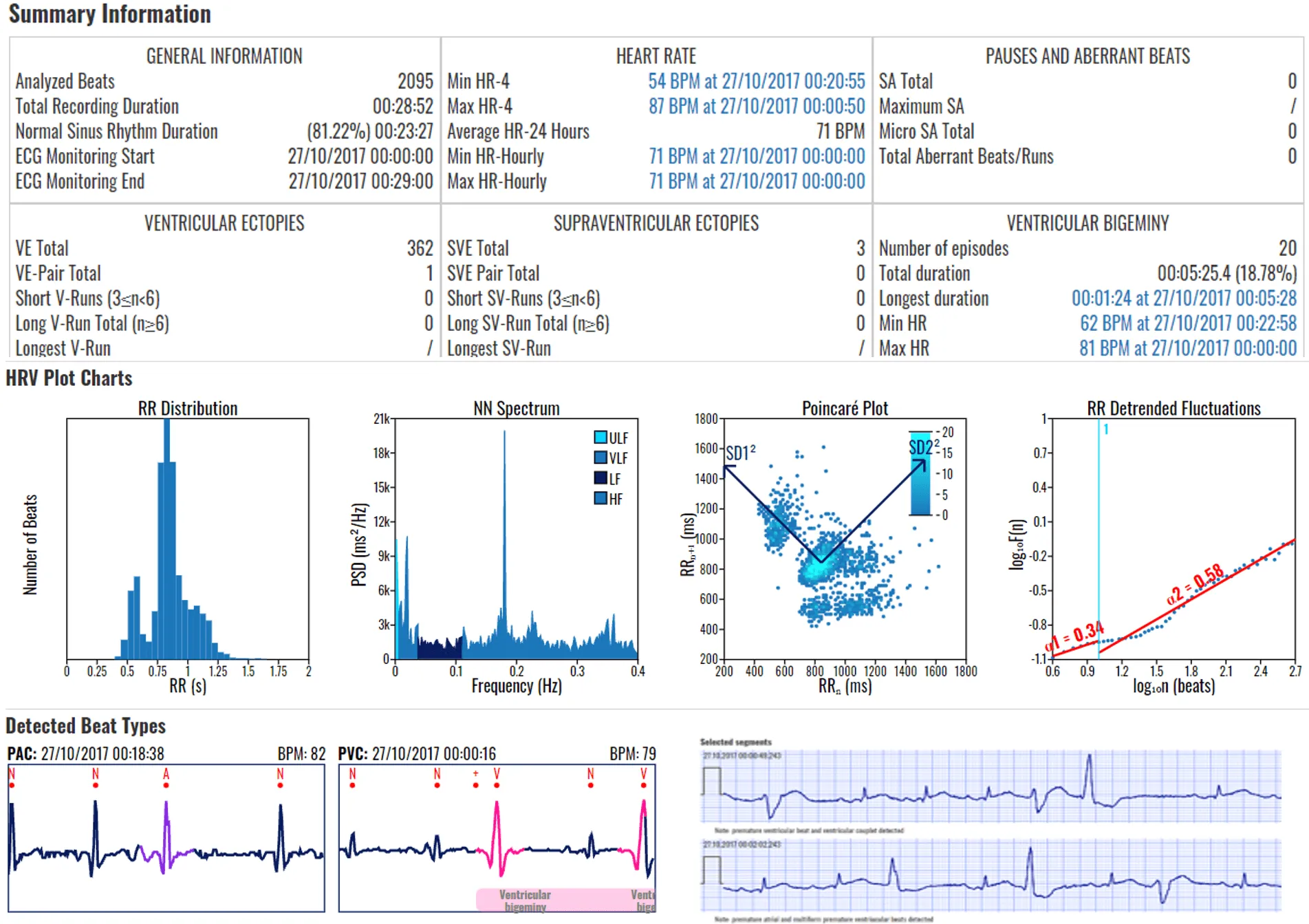 A page of a mobile cardiac telemetry report: summary statistics, HRV plot charts and annotated PAC and PVC beat examples