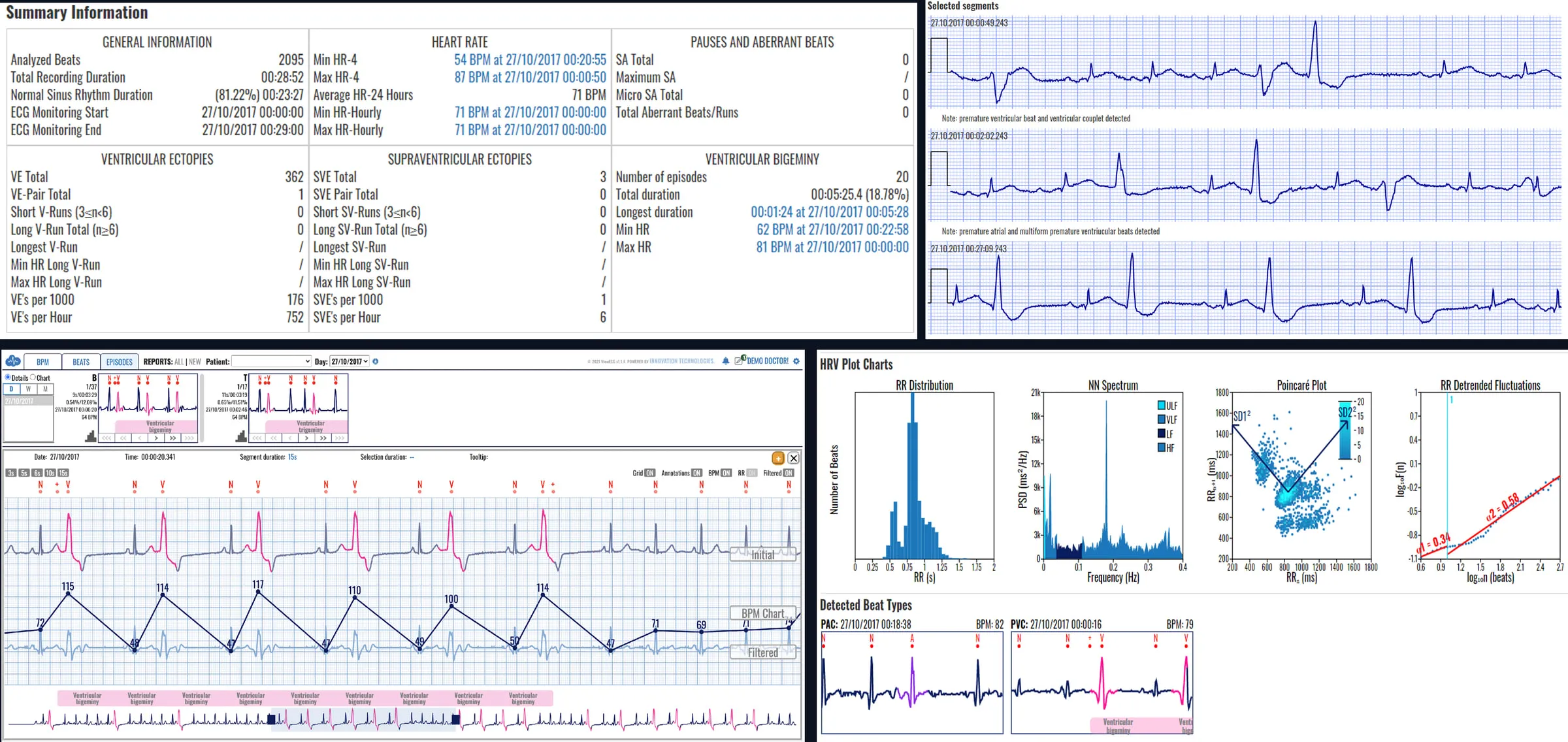 A mobile cardiac telemetry report in the review platform: summary statistics, annotated ECG segments, beat-by-beat navigation and HRV plots